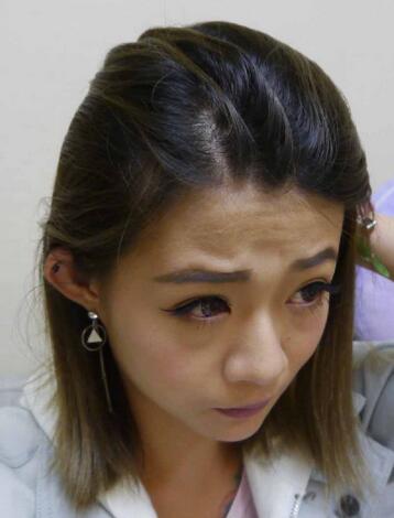 抬頭紋祛除x果圖