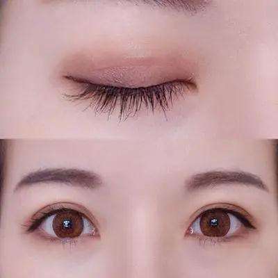 北京割雙眼皮多少錢