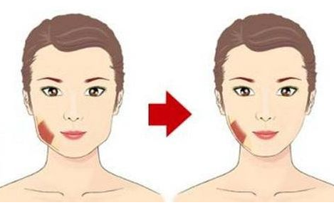 咬肌切除手術(shù)風(fēng)險(xiǎn)大么