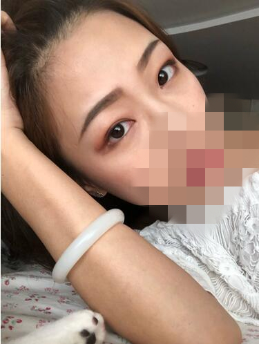 谷琪醫(yī)生-簡介資料-附內(nèi)切法祛眼袋案例