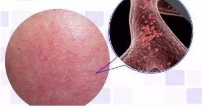 彩光嫩膚原理解析