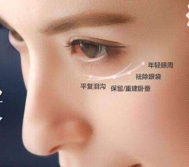 眼袋整型的方式有哪些？各自的果怎么樣？