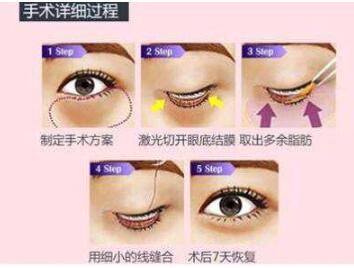 眼袋整形手術