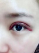 【案例】全切雙眼皮手術(shù)恢復(fù)的全過程,記錄起來