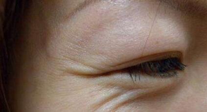 去除魚尾紋有哪些方法?