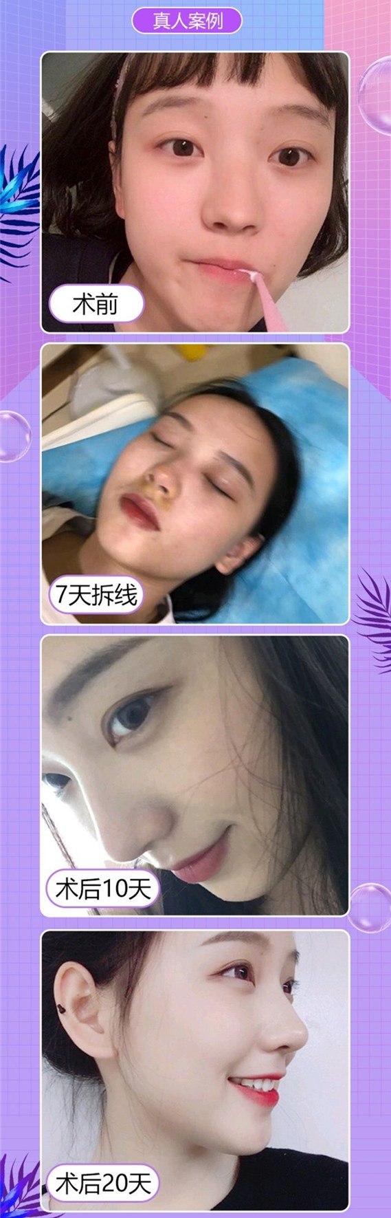 假體隆鼻的優(yōu)勢(shì)