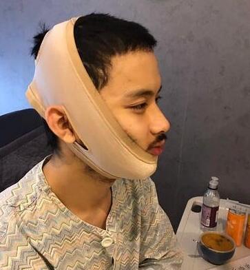 男性過(guò)大下頜角整形