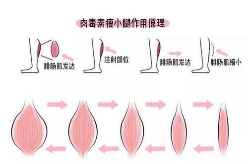 注射瘦腿有用嗎