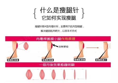 注射瘦腿有用嗎