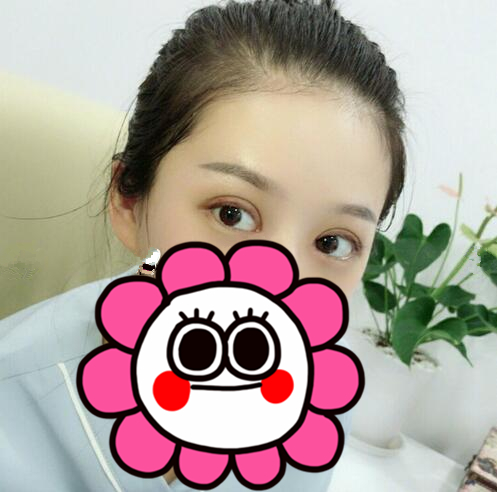 深圳陽光醫(yī)院雙眼皮案例