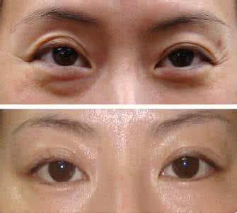 眼部除皺