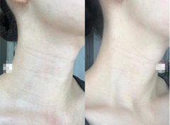 做完大熱的液態(tài)超聲提拉后 煩人的頸紋變淺不少