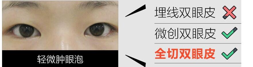 雙眼皮適合人群
