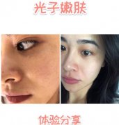 林秋蓉醫(yī)生做光子嫩膚體驗(yàn)過程心得分享 嫩如布??！