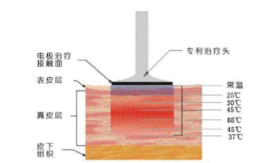 電波拉皮手術(shù)費用