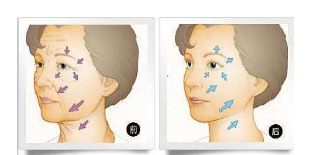 電波拉皮手術(shù)費用