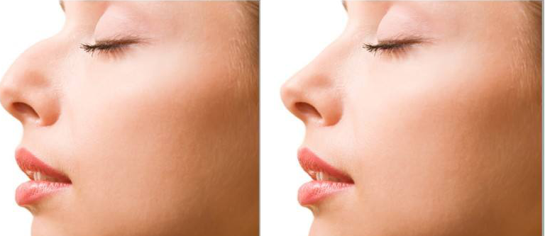 駝峰鼻整形一定要磨鼻梁骨嗎？鼻型不一定要一定筆直！