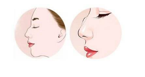 駝峰鼻整形一定要磨鼻梁骨嗎？鼻型不一定要一定筆直！