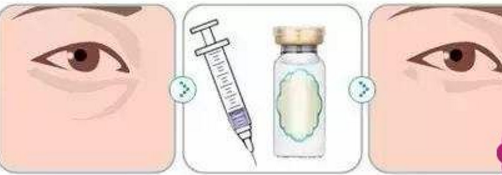 眼角皺紋除皺你以為保養(yǎng)品就能解決？還得靠醫(yī)美~