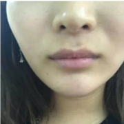 蔣正華醫(yī)生玻尿酸豐唇案例