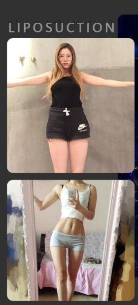 湯穎峰醫(yī)生手術(shù)案例