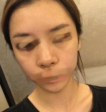 進(jìn)口膨體隆鼻案例