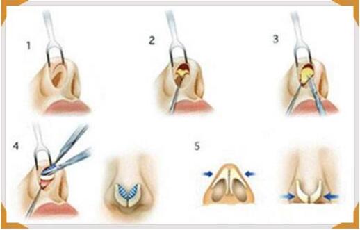 隆鼻假體壽命有多長(zhǎng)