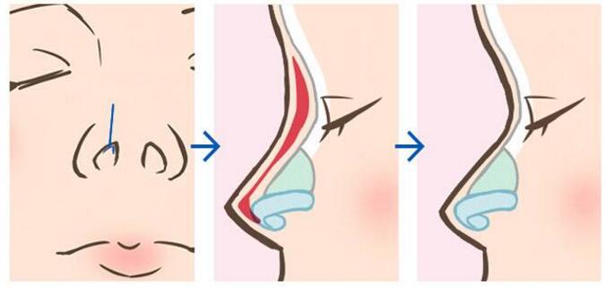 隆鼻假體壽命有多長(zhǎng)