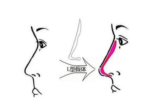 隆鼻假體壽命有多長(zhǎng)