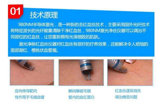 激光去除紅血絲