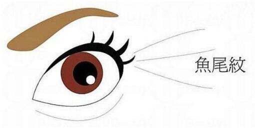 天生魚尾紋做什么手術(shù)去除好？