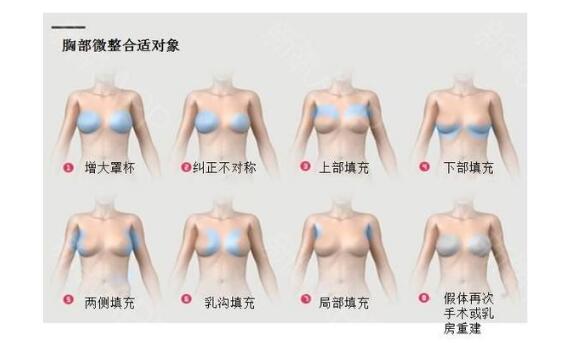 胸部整形失敗修復(fù)