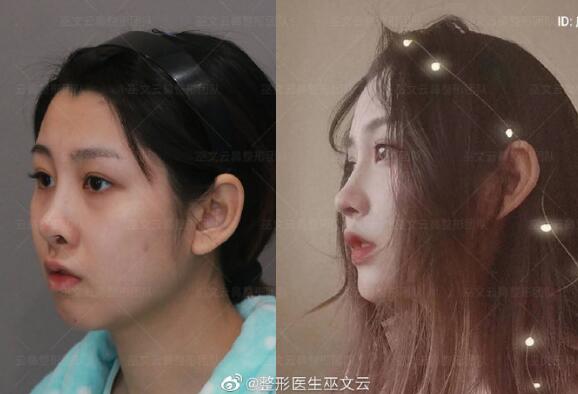 巫文云隆鼻修復(fù)案例