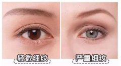 眼周容易產(chǎn)生皺紋原因詳細(xì)介紹 你保養(yǎng)的方法可能不對