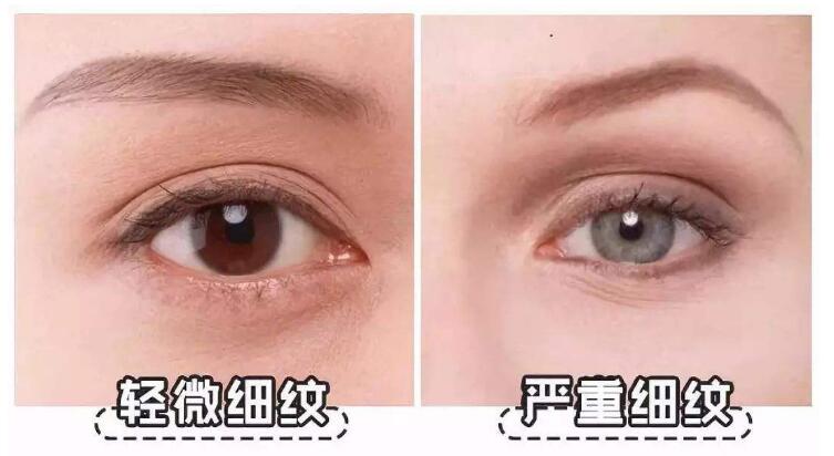 眼周容易產(chǎn)生皺紋原因詳細(xì)介紹