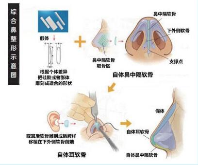 6大火爆隆鼻項(xiàng)目詳細(xì)對(duì)比介紹
