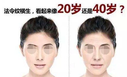 這些玻尿酸注射法令紋沒問題要點一定要記住