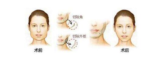 這些科學(xué)有的下頜線變美方法能夠幫助你快速打造側(cè)臉美