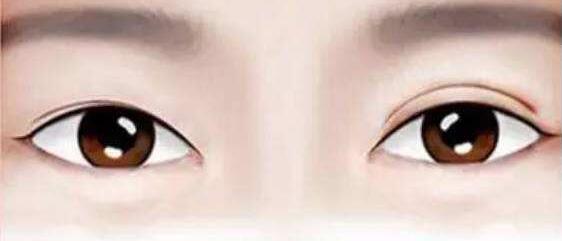 對(duì)引起割雙眼皮術(shù)后出現(xiàn)肉條的原因進(jìn)行詳細(xì)分析