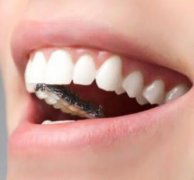 大連牙齒美容整形哪家醫(yī)院好 地包天矯正價格貴不