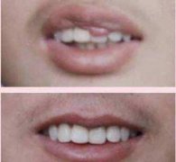 什么是重唇  西寧華美整形醫(yī)院重唇整形會留疤痕嗎