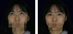 眼部綜合 眼睛變大了以后臉都顯小了