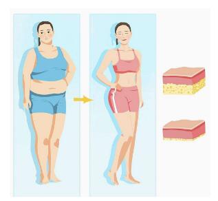 這個(gè)吸脂層次要做的好了