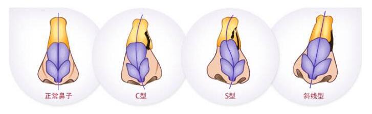 做了歪鼻整形，臉都變美了，難怪明星都要搶著做