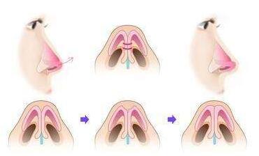 大鼻頭整形做的好