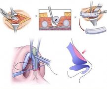 肋軟骨隆鼻 一次手術(shù)解決很多次的繁瑣化妝