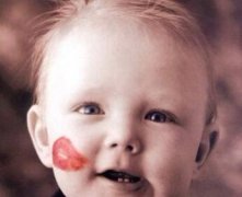 天津河東整形醫(yī)院激光去血管瘤的優(yōu)勢 適應哪些情況呢