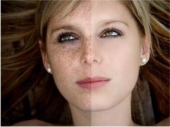 云南妤繡整形醫(yī)院激光去黃褐斑的果怎么樣 會復發(fā)嗎