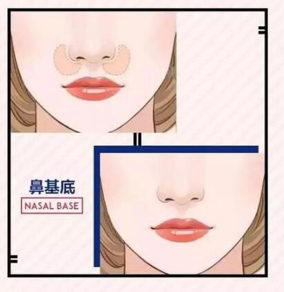 對鼻基底進(jìn)行填充的作用