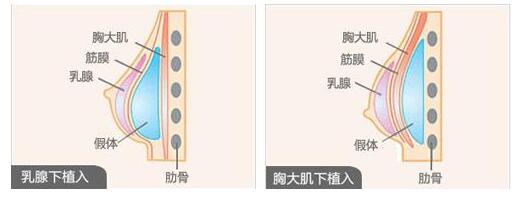 這樣子做隆胸手術(shù)